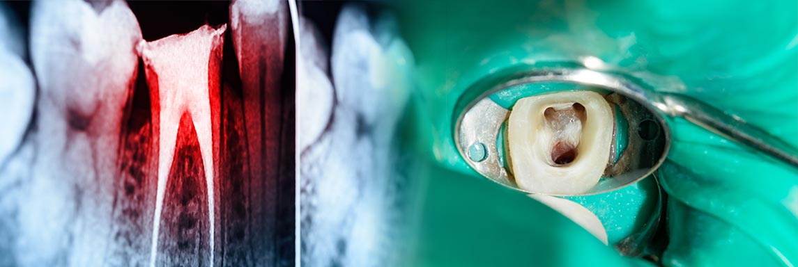 Dentista Monza endodonzia e cura della carie