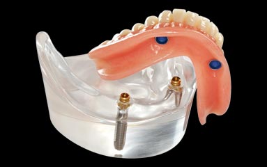 Overdenture su impianti