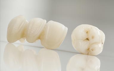 Protesi fissa in Zirconia